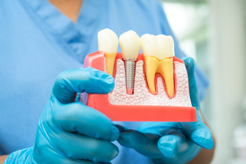 Dentist holding a dental implant model showing a titanium implant post and crown between natural teeth, used to explain dental implant cost and treatment