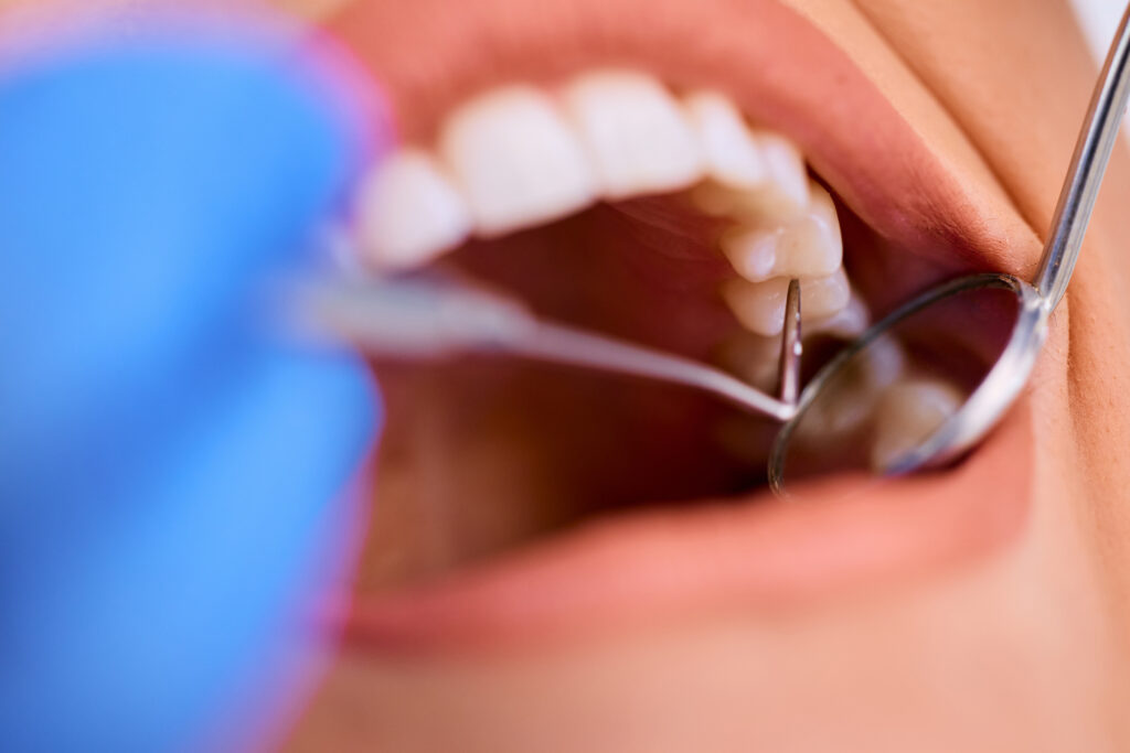 A dentist in a blue glove uses a dental probe and mirror to check a patient's back teeth.