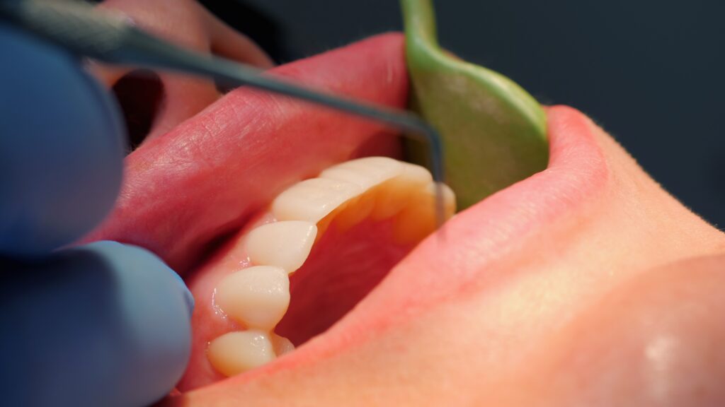 Dentist using a dental instrument to check the upper teeth for plaque and tartar during a check-up